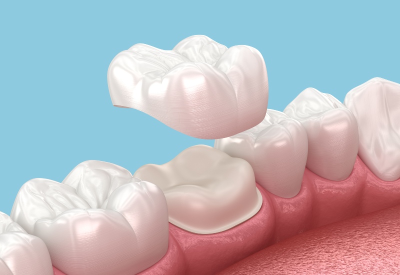 A 3D illustration of crown placement, featuring a tooth ready for restoration in Terre Haute, IN