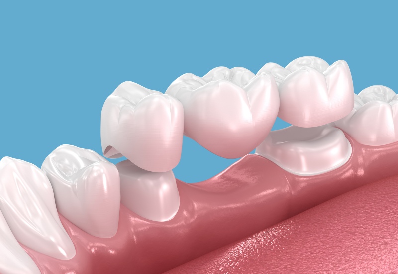 A 3D rendering showcasing the placement of a dental bridge within a dental arch in Terre Haute, IN